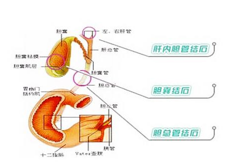 胆结石的食疗方法 如何预防胆结石